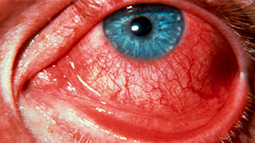 conjuntivitis