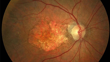degeneracion macula