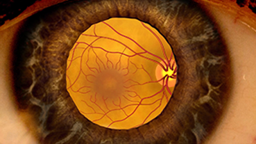 edema macular