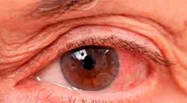 glaucoma